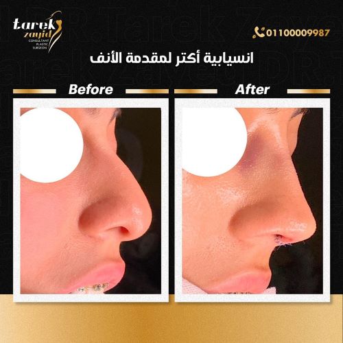 تجميل الأنف قبل وبعد بالصور